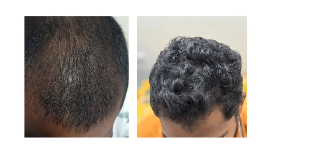 Hair Fall