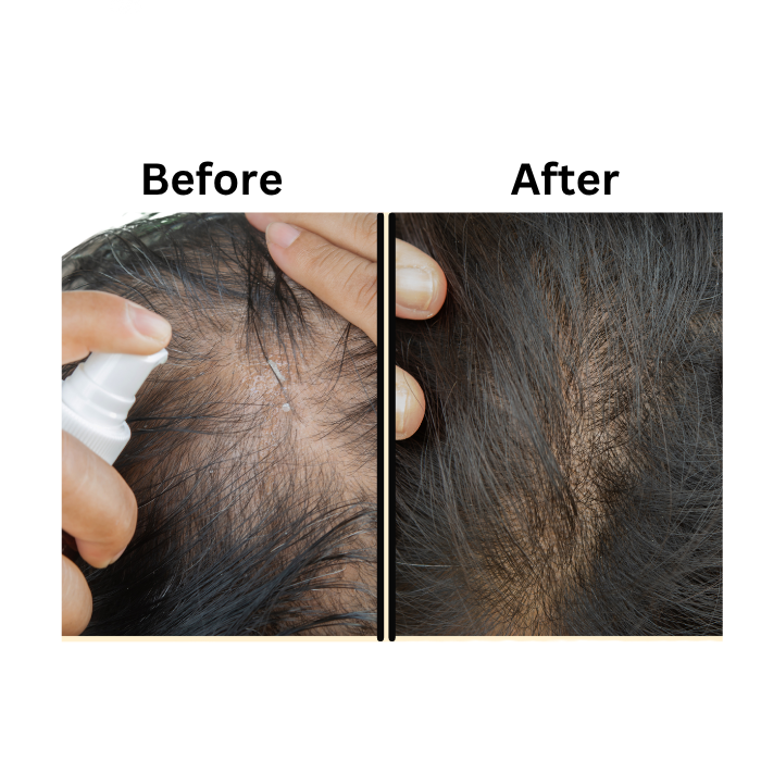hair transplant in Hyderabad