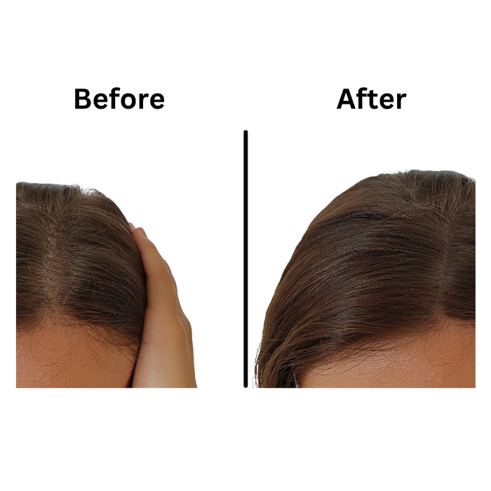 hair transplant in Hyderabad