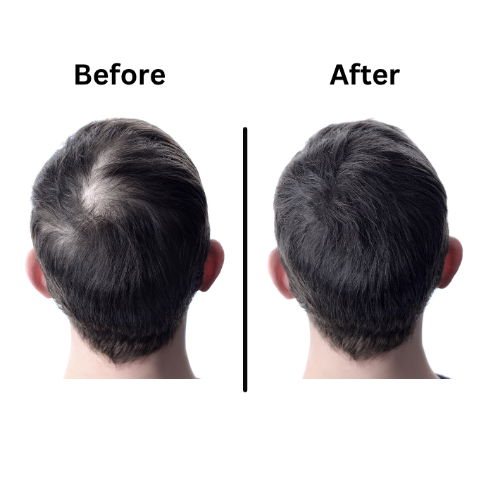 hair transplant in Hyderabad