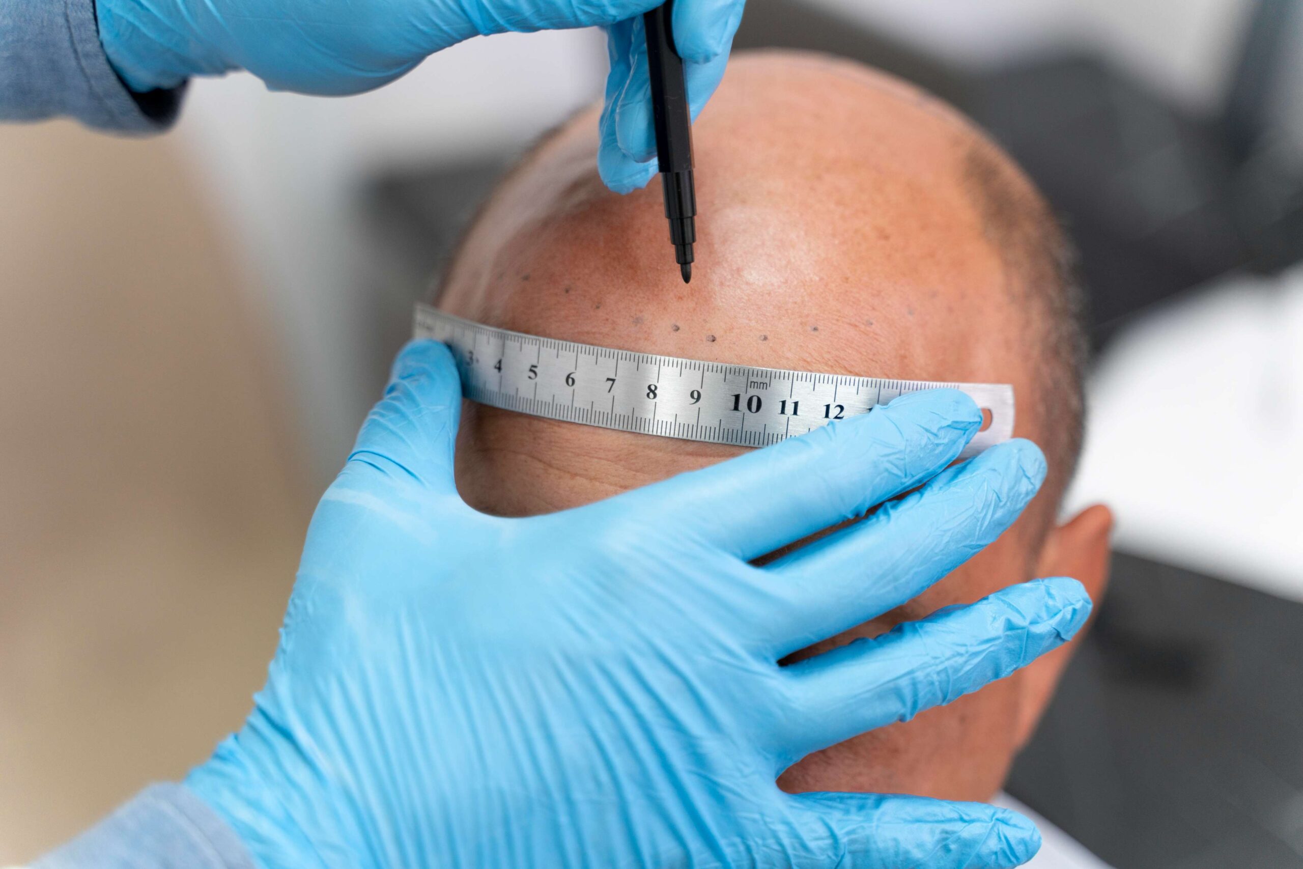 hair transplant in hyderabad